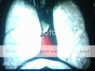 HeartLungs-Healthy-1.jpg picture by mishNotmush